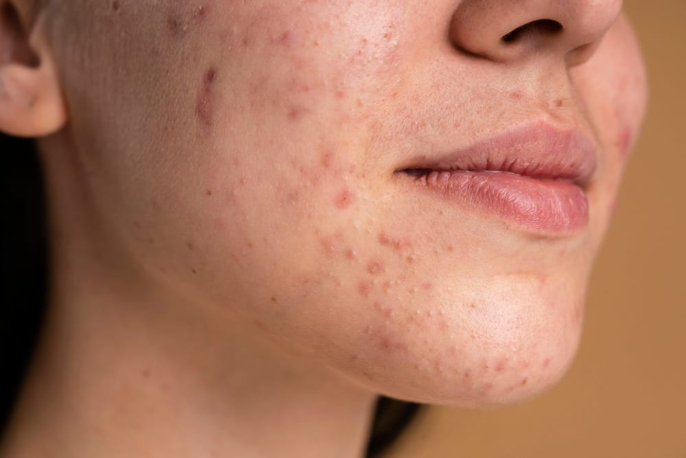 Young Women with Acne on face